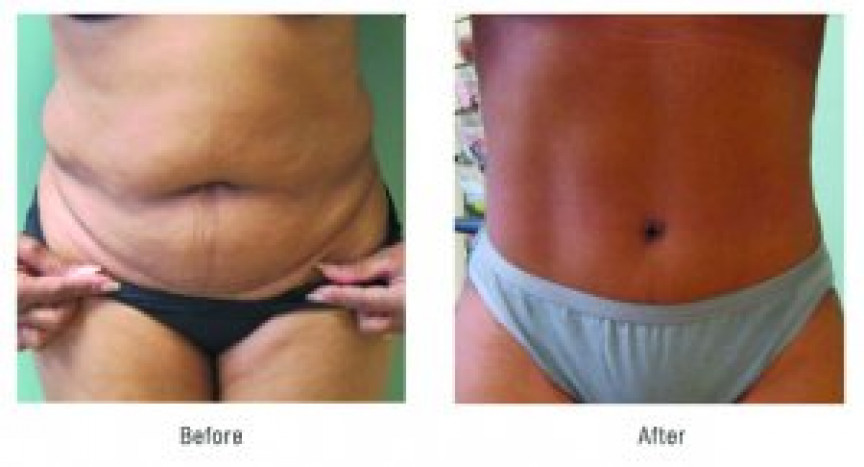 Front Tummy Tuck - Before and After